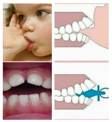 Hábitos orales de la infancia